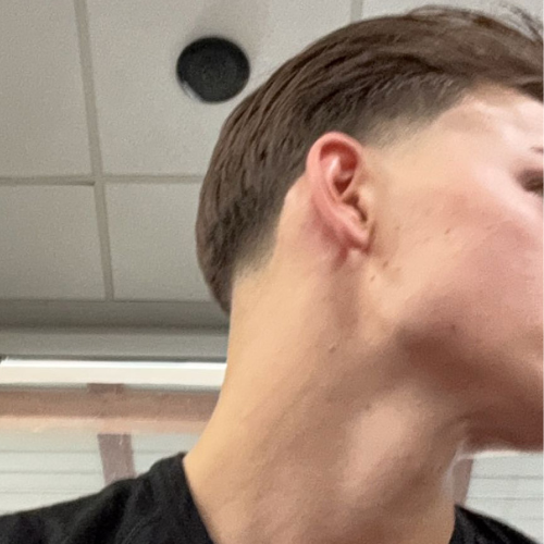 Nachher: Kieferlinie nach Jawline Gum Training